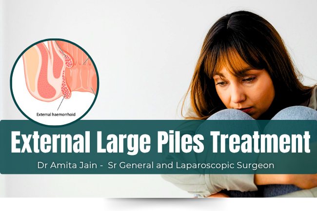 Specialised Treatment for external large Piles by Dr Amita Jain